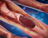 What is thrombosis and how blood clots occur in the body. Minimally invasive treatments and prevention methods