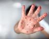 Explosion of measles cases in Dolj since the beginning of the year